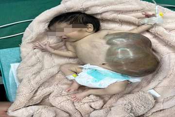 انجام موفقیت‌آمیز عمل جراحی کیست مادرزادی جدار شکم بر روی نوزاد ۱۱ روزه در مرکز آموزشی درمانی 17 شهریور